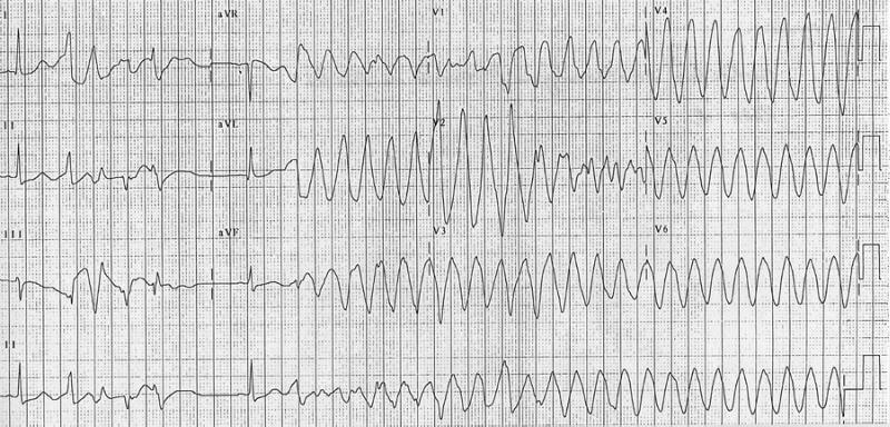 Twelve-lead electrocardiogram showing torsades de pointes, with characteristic twisting of QRS complexes around the isoelectric baseline, in a patient with hypokalemia and prolonged QT interval.
