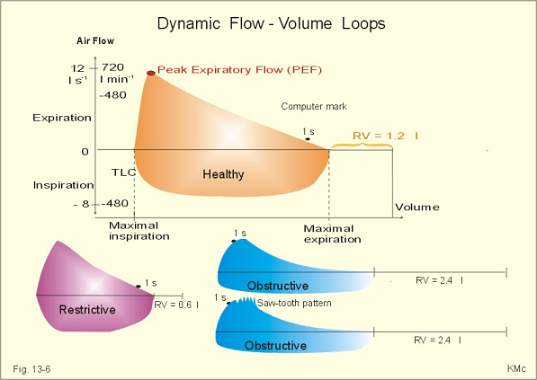 kyphoscoliosis flow volume loop